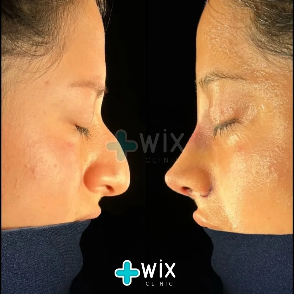 Rhinoplasty Before and After