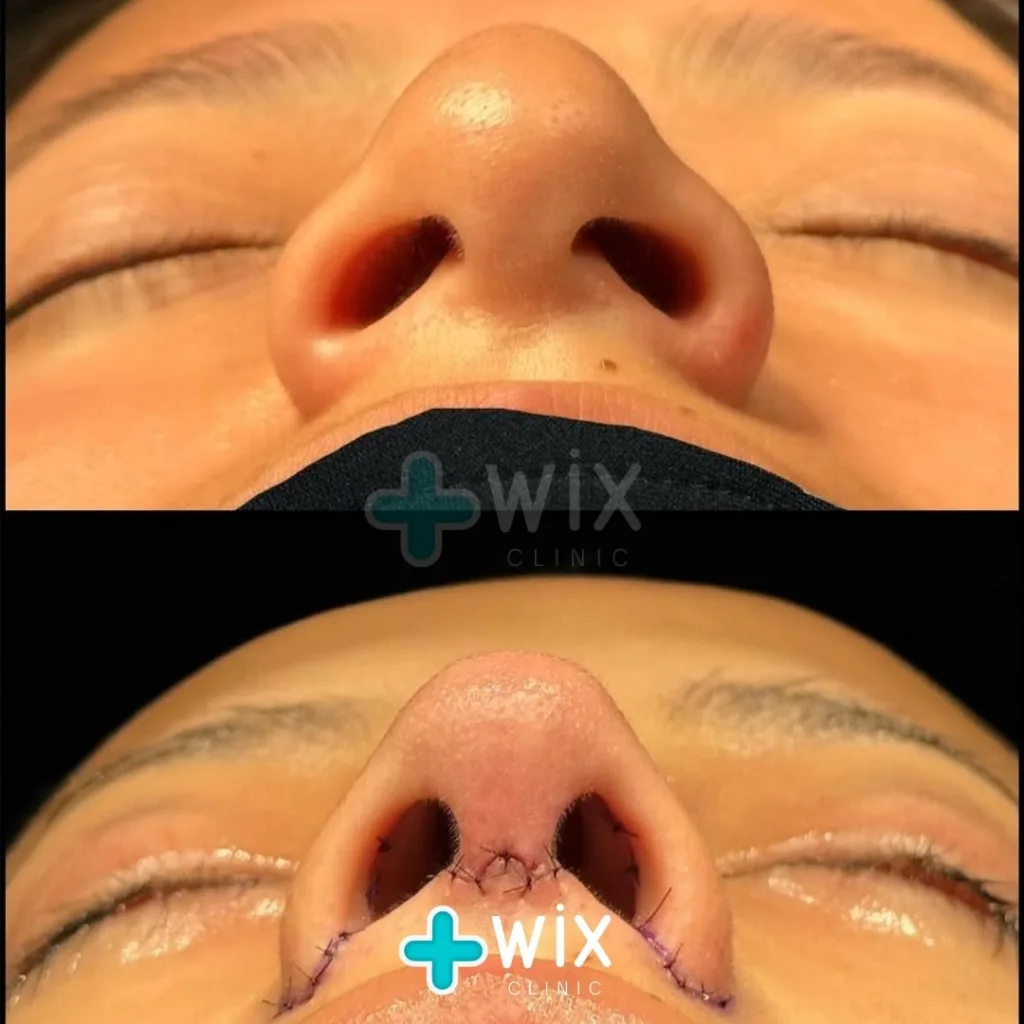 Rhinoplasty Before and After