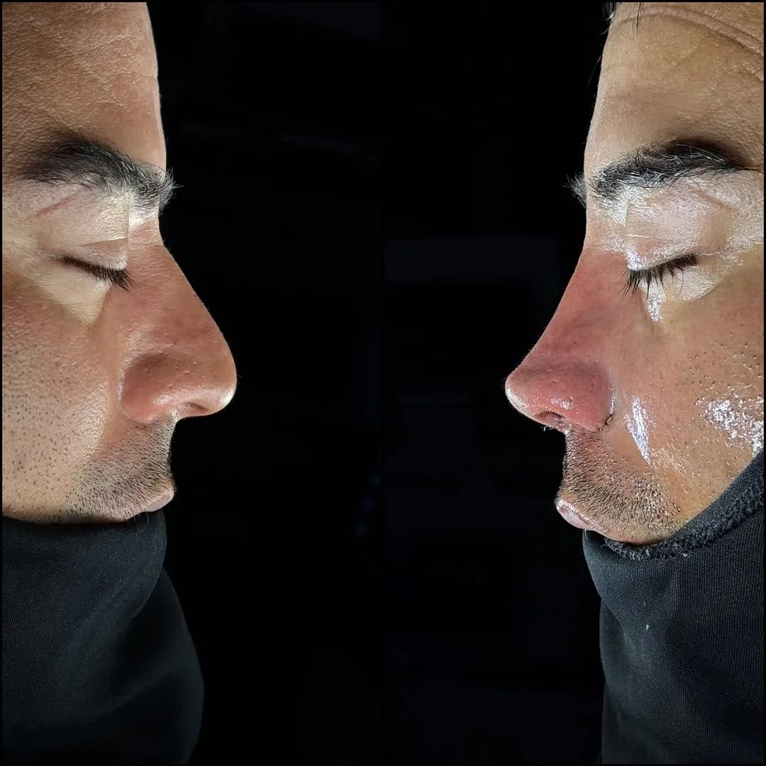 Rhinoplasty Before and After