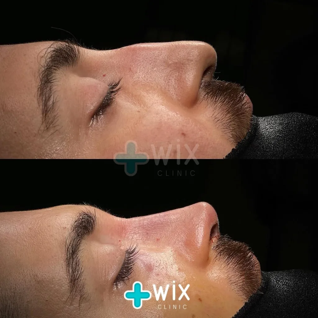 Rhinoplasty Before and After