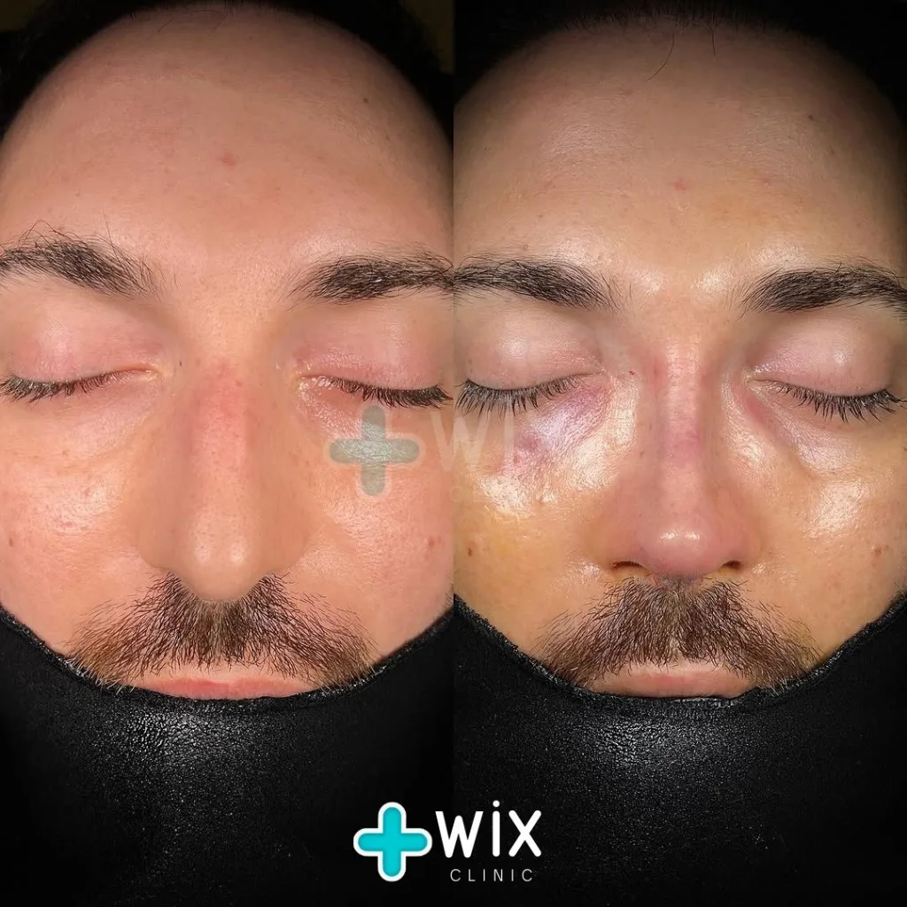 Rhinoplasty Before and After