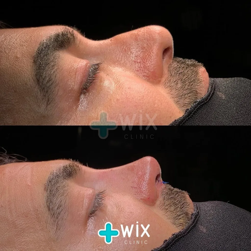 Rhinoplasty Before and After