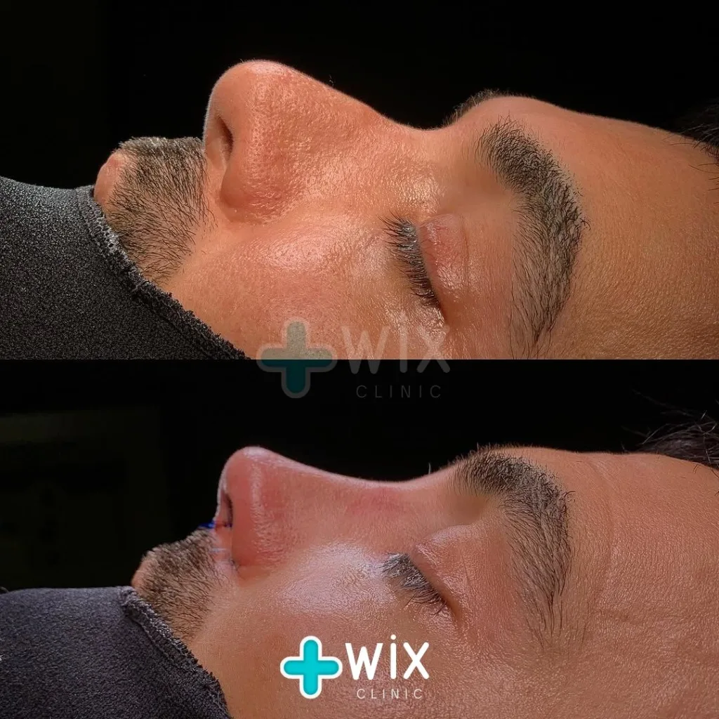 Rhinoplasty Before and After