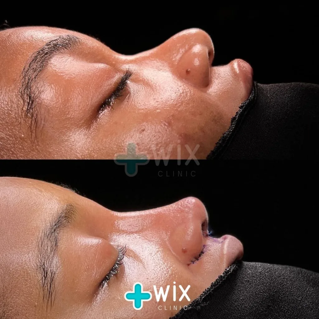 Rhinoplasty Before and After