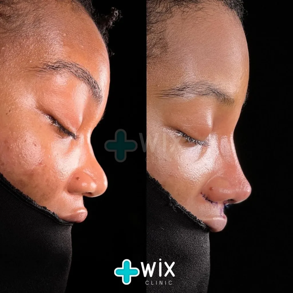 Rhinoplasty Before and After