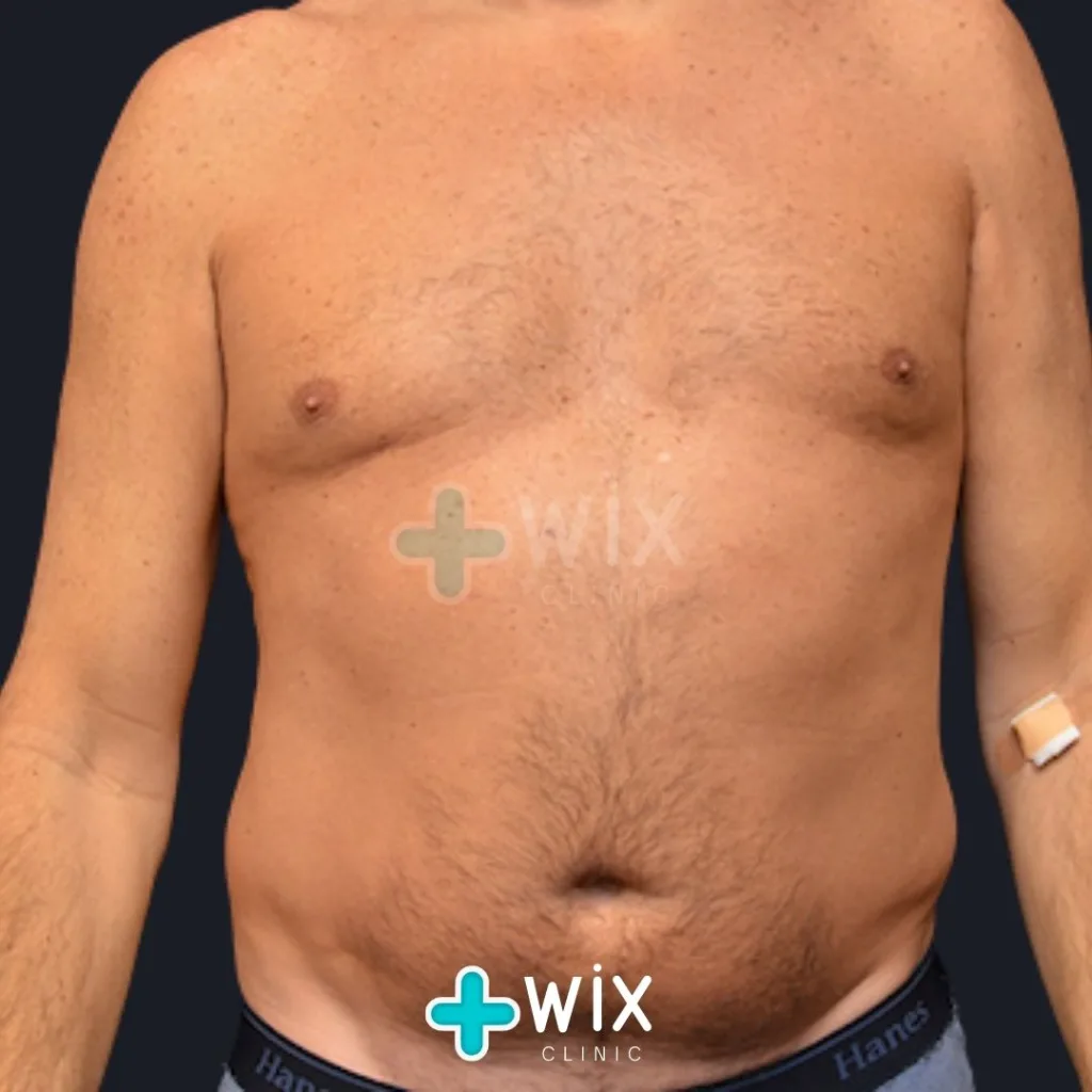 Six Pack Surgery Before and After