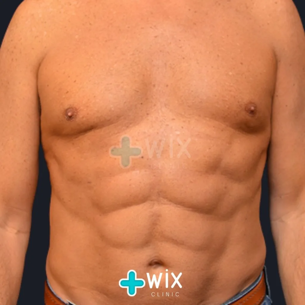 Six Pack Surgery Before and After