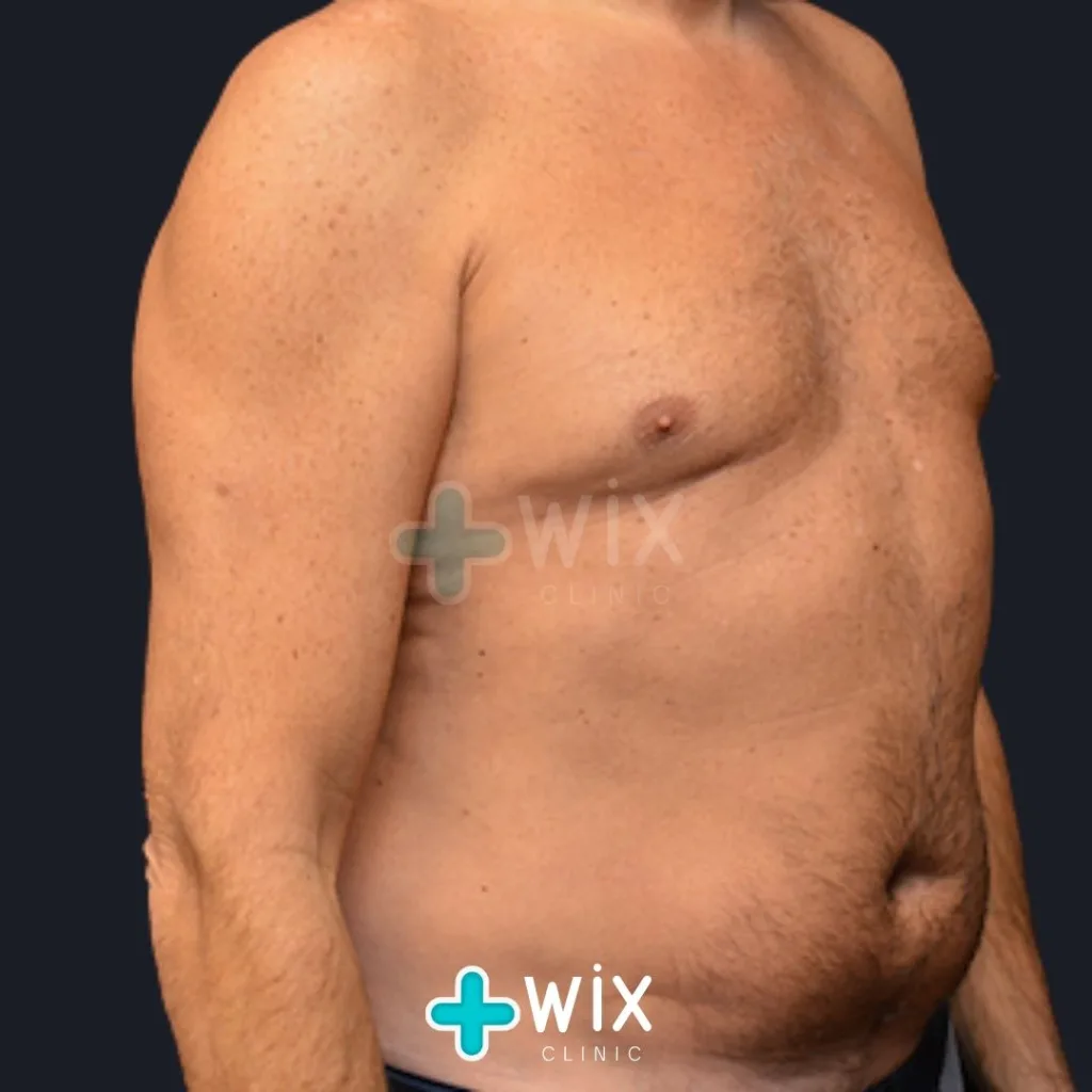 Six Pack Surgery Before and After