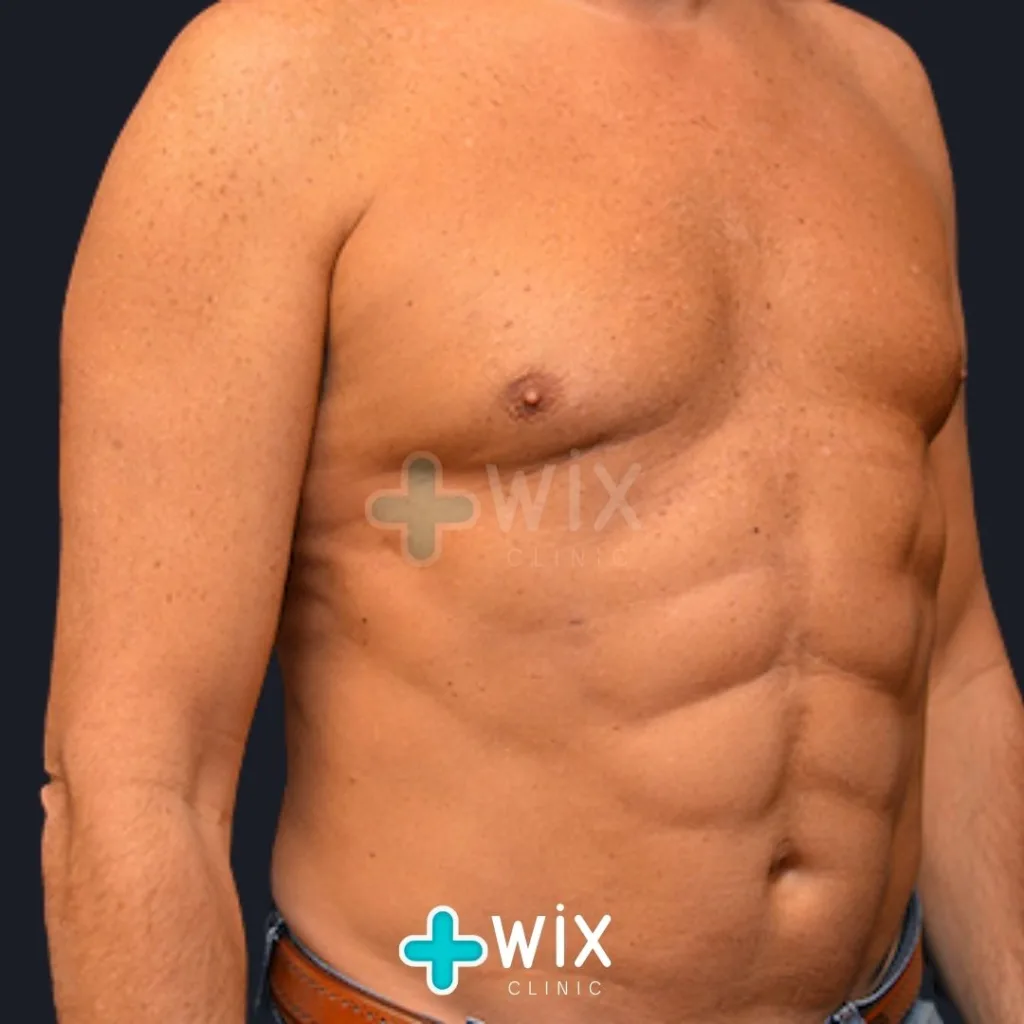 Six Pack Surgery Before and After