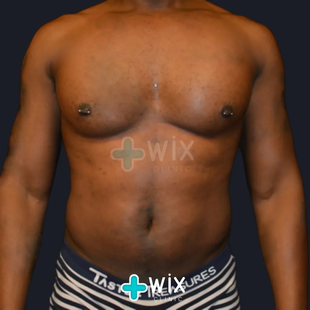 Six Pack Surgery Before and After