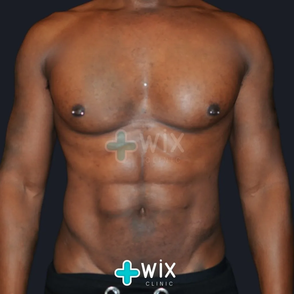 Six Pack Surgery Before and After