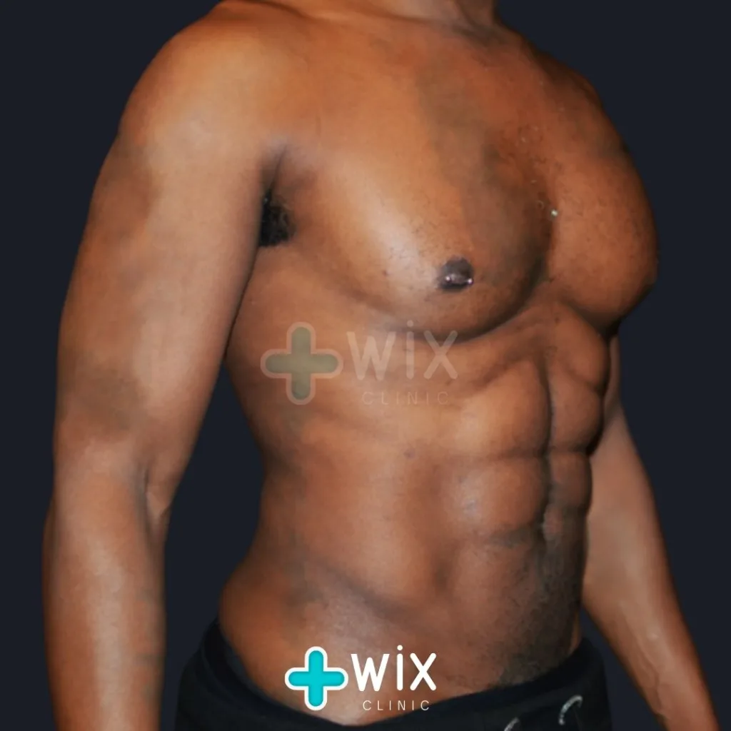 Six Pack Surgery Before and After