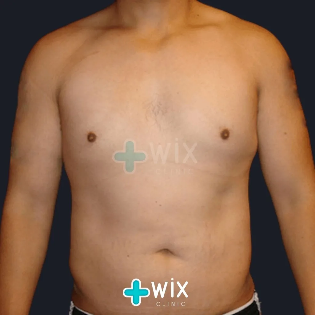 Six Pack Surgery Before and After