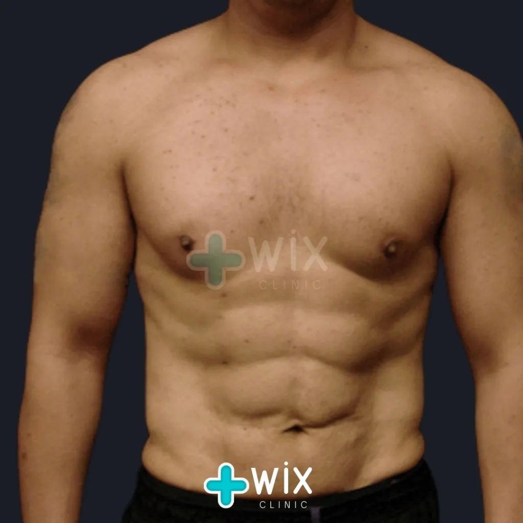 Six Pack Surgery Before and After