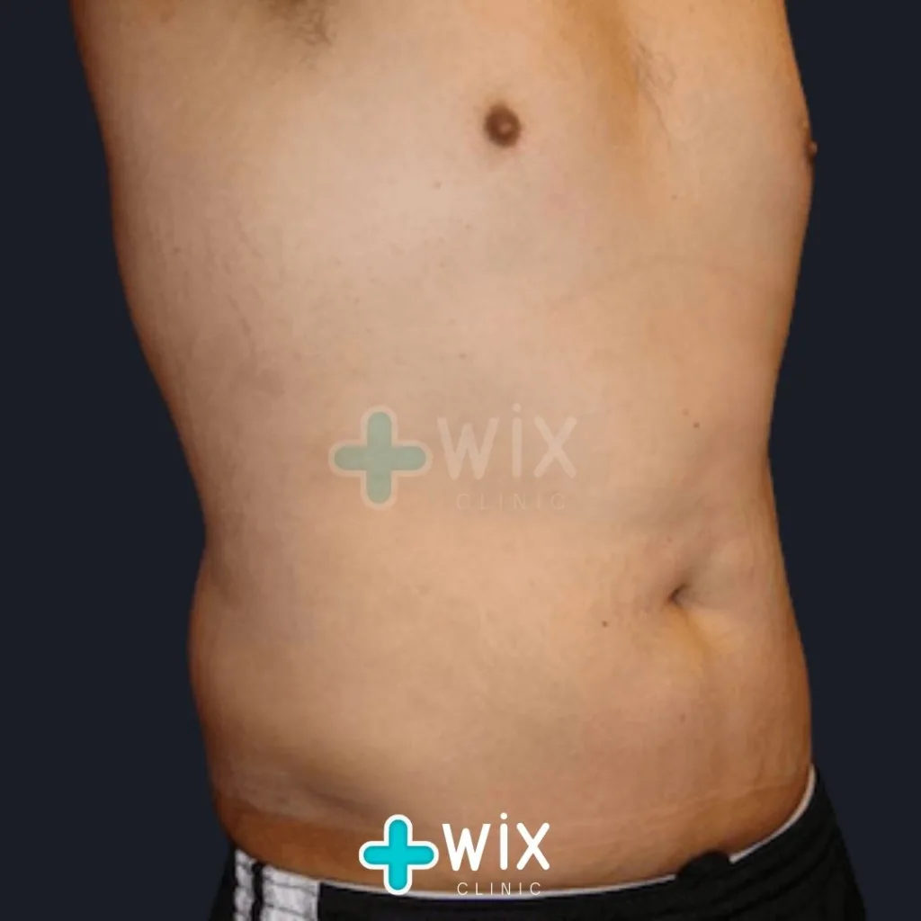 Six Pack Surgery Before and After