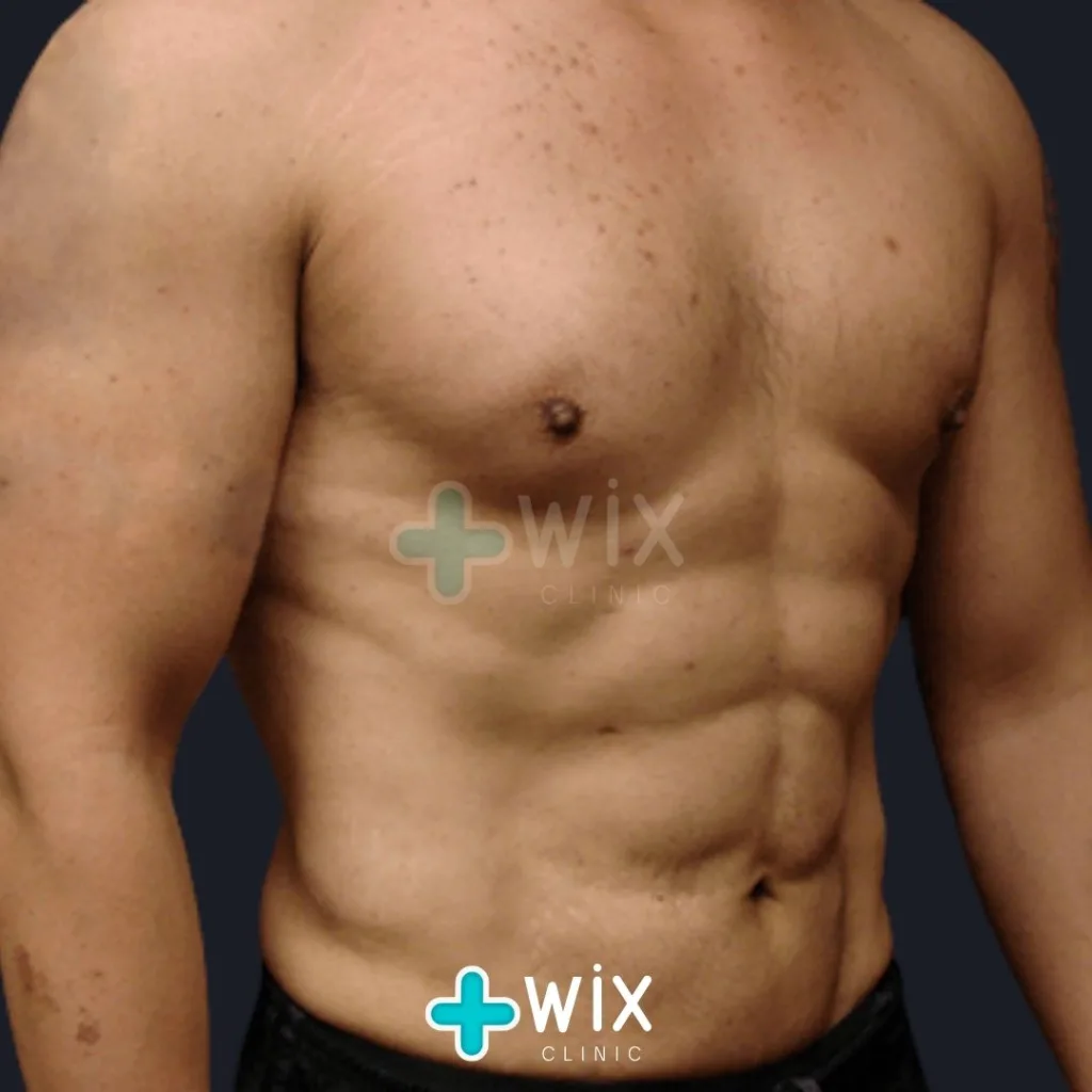 Six Pack Surgery Before and After