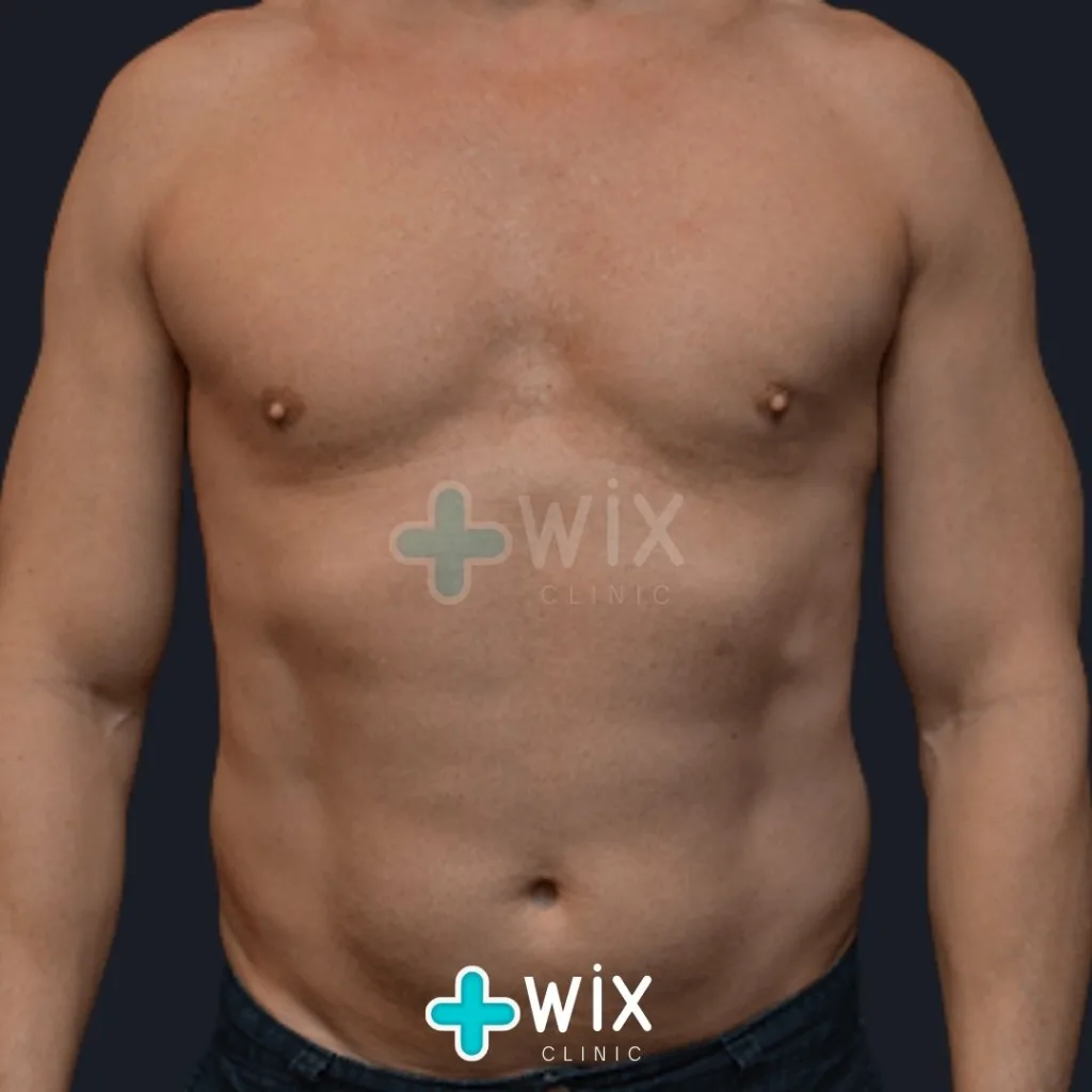 Six Pack Surgery Before and After