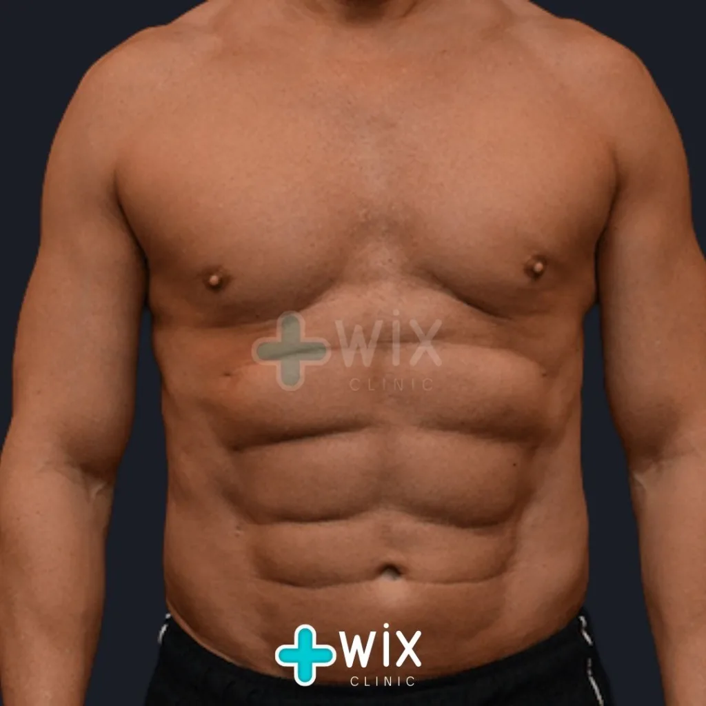 Six Pack Surgery Before and After