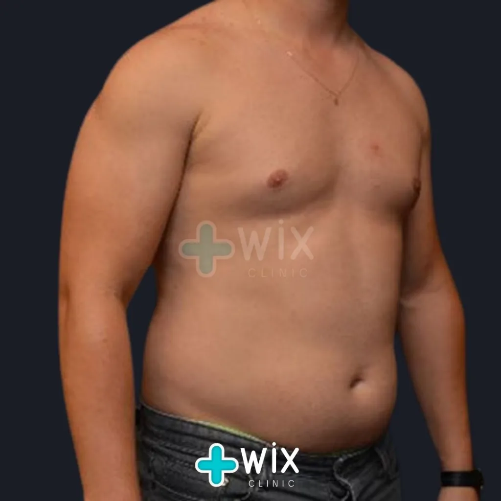 Six Pack Surgery Before and After