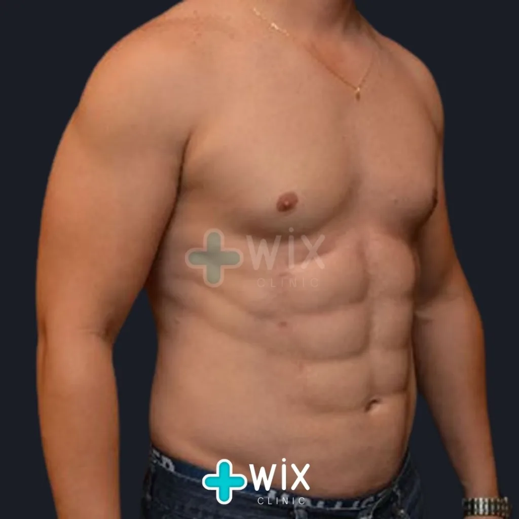 Six Pack Surgery Before and After