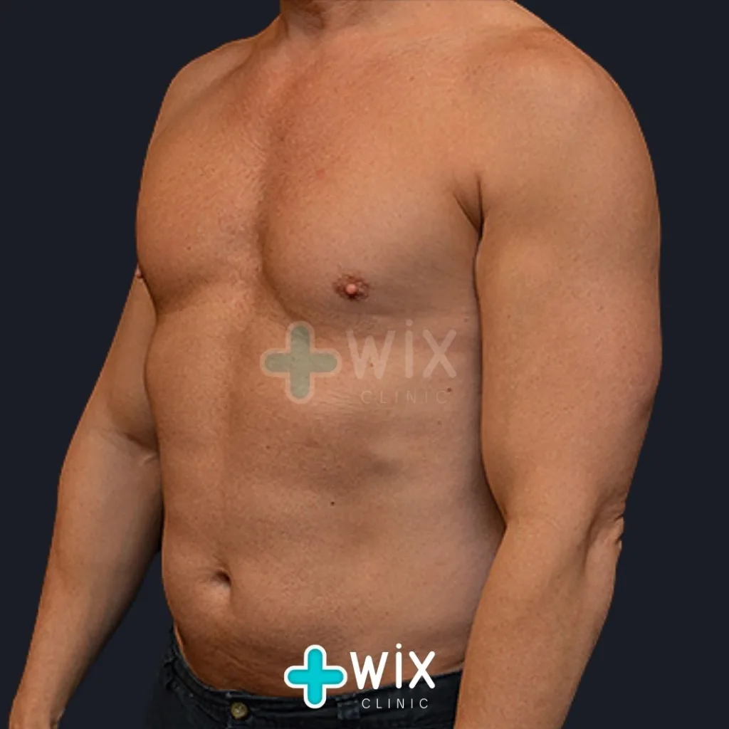 Six Pack Surgery Before and After