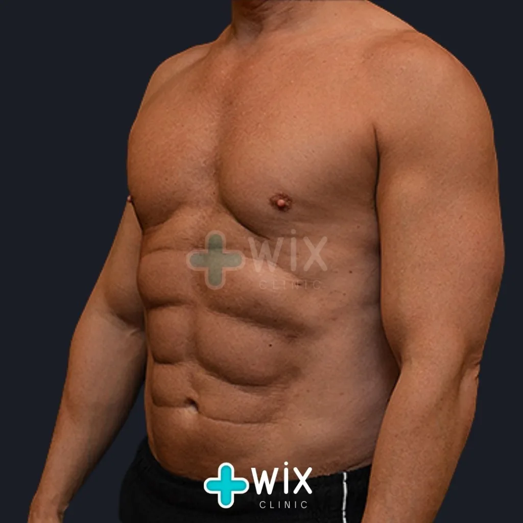 Six Pack Surgery Before and After