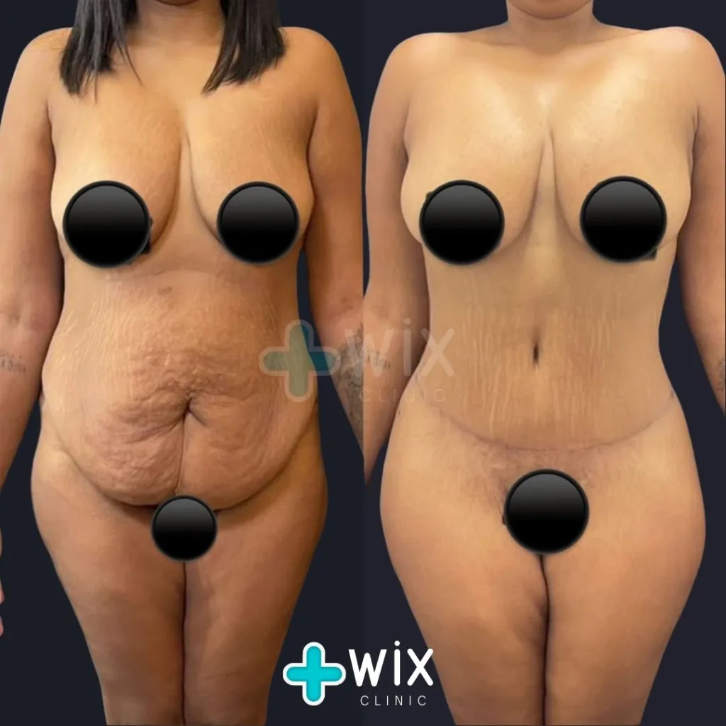 Tummy Tuck Before and After