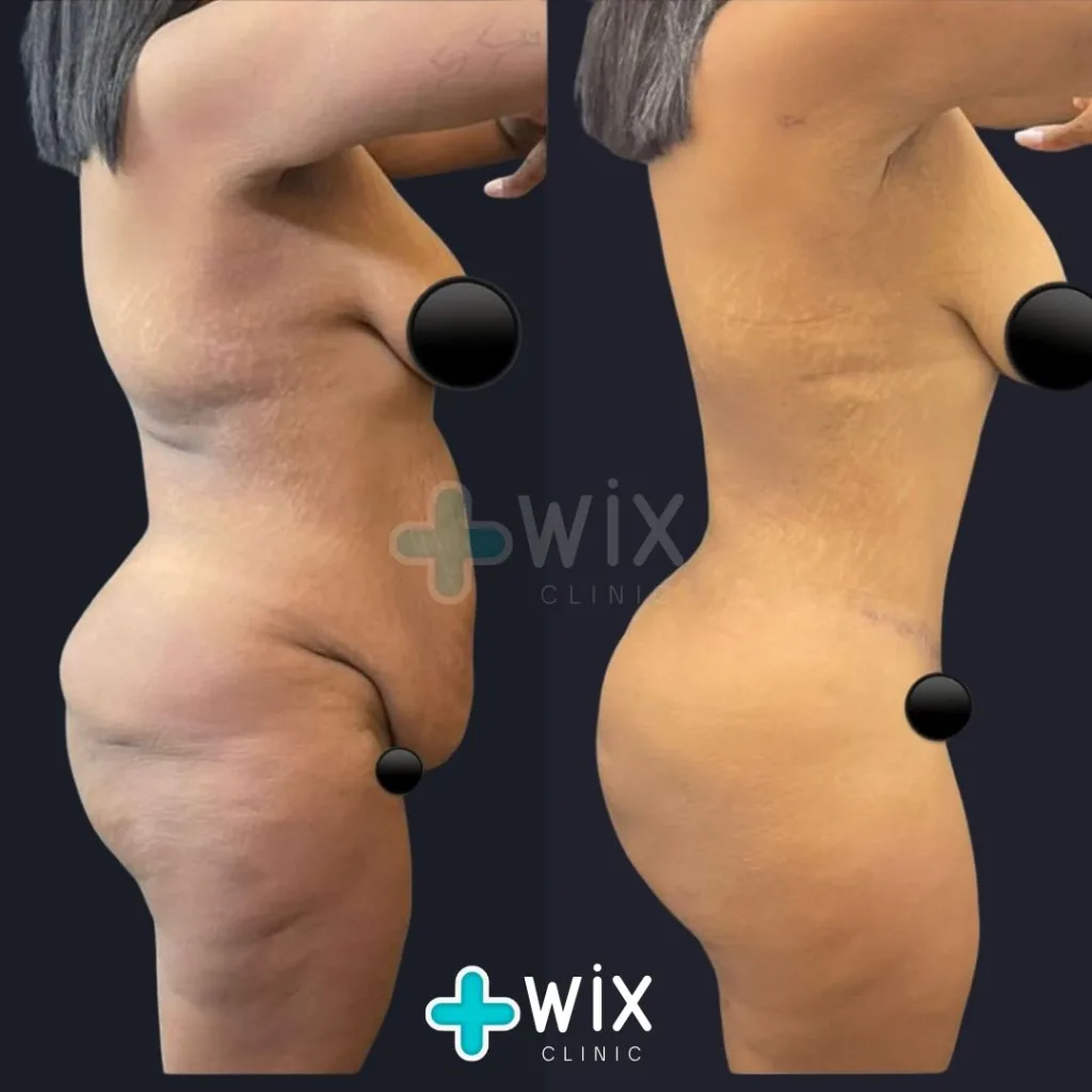 Tummy Tuck Before and After