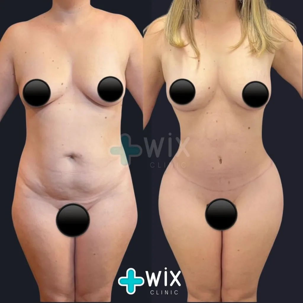 Tummy Tuck Before and After