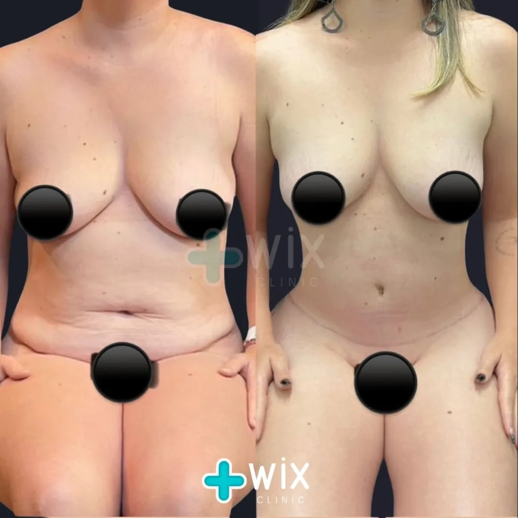 Tummy Tuck Before and After