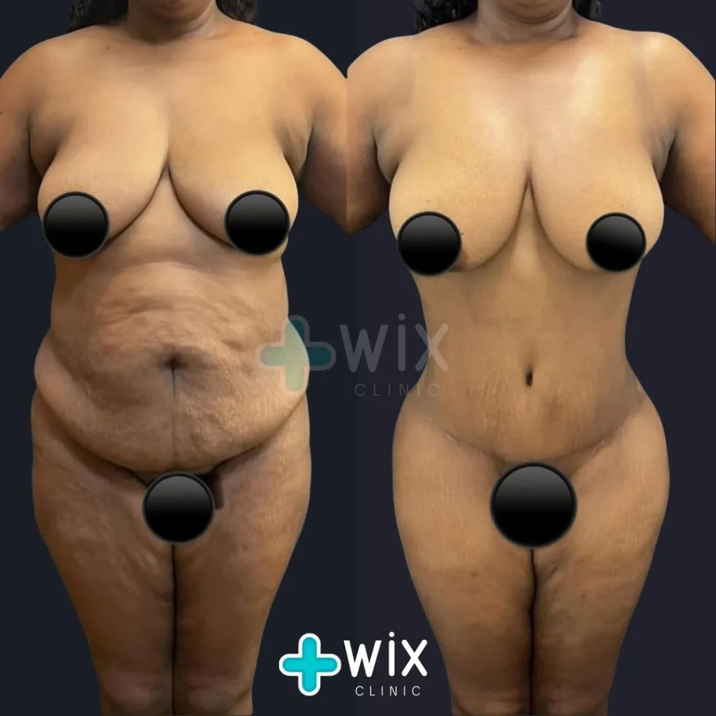 Tummy Tuck Before and After