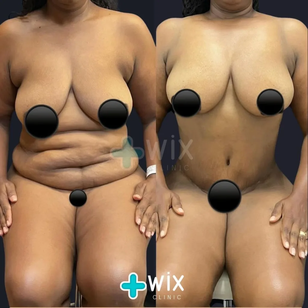 Tummy Tuck Before and After