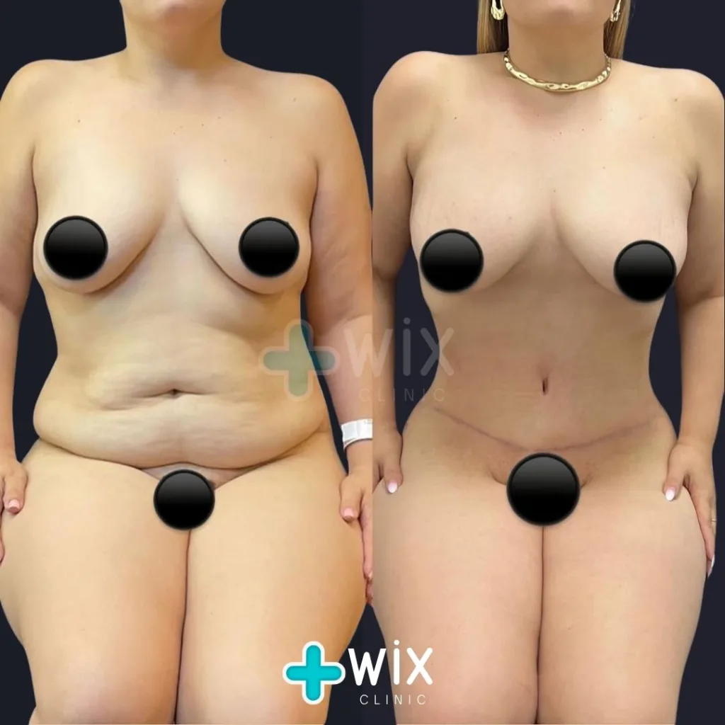 Tummy Tuck Before and After