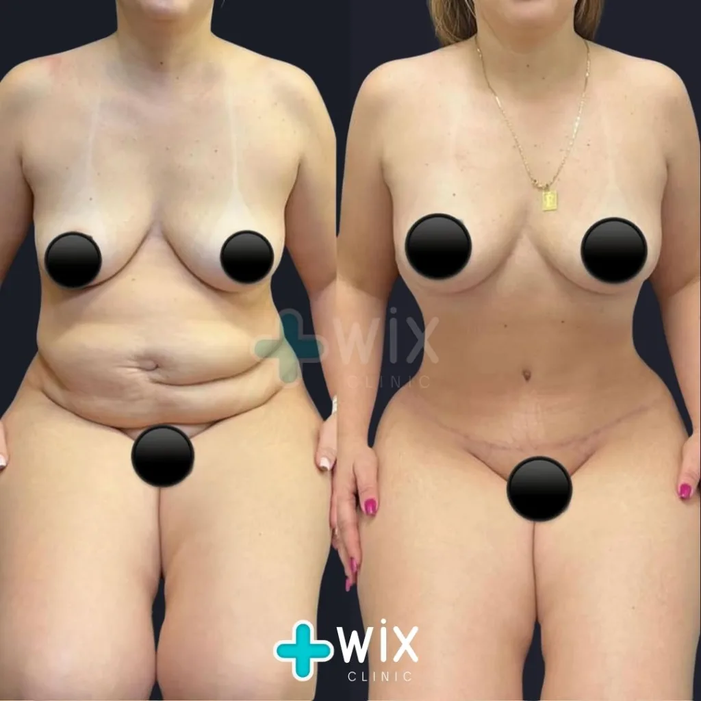 Tummy Tuck Before and After