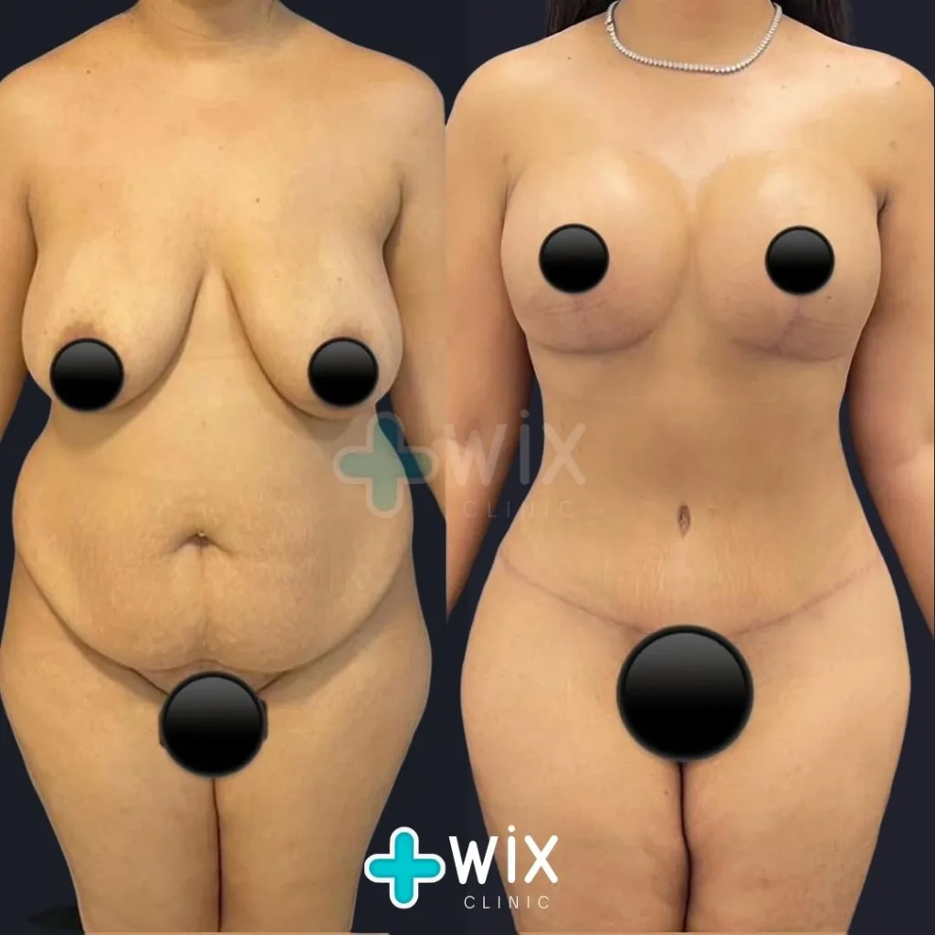 Tummy Tuck Before and After