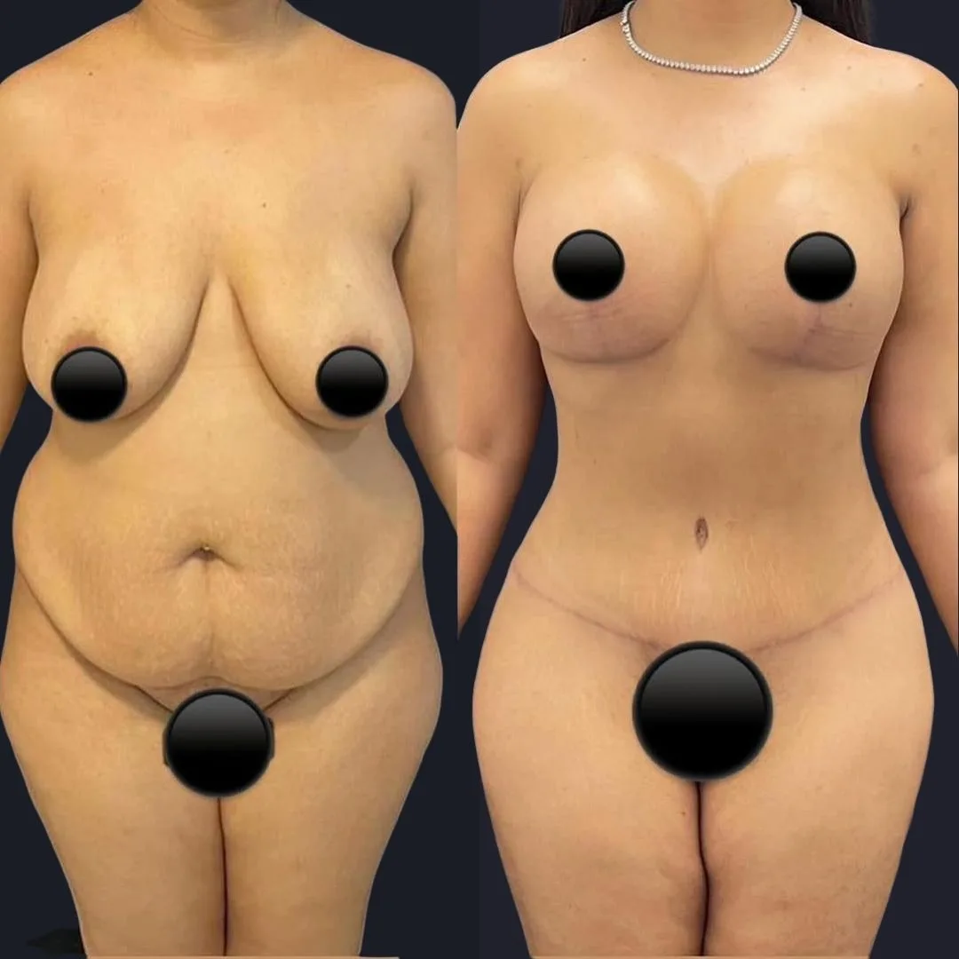 Tummy Tuck in Turkey Before and After