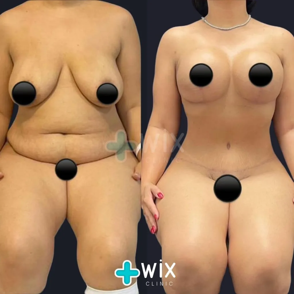 Tummy Tuck Before and After