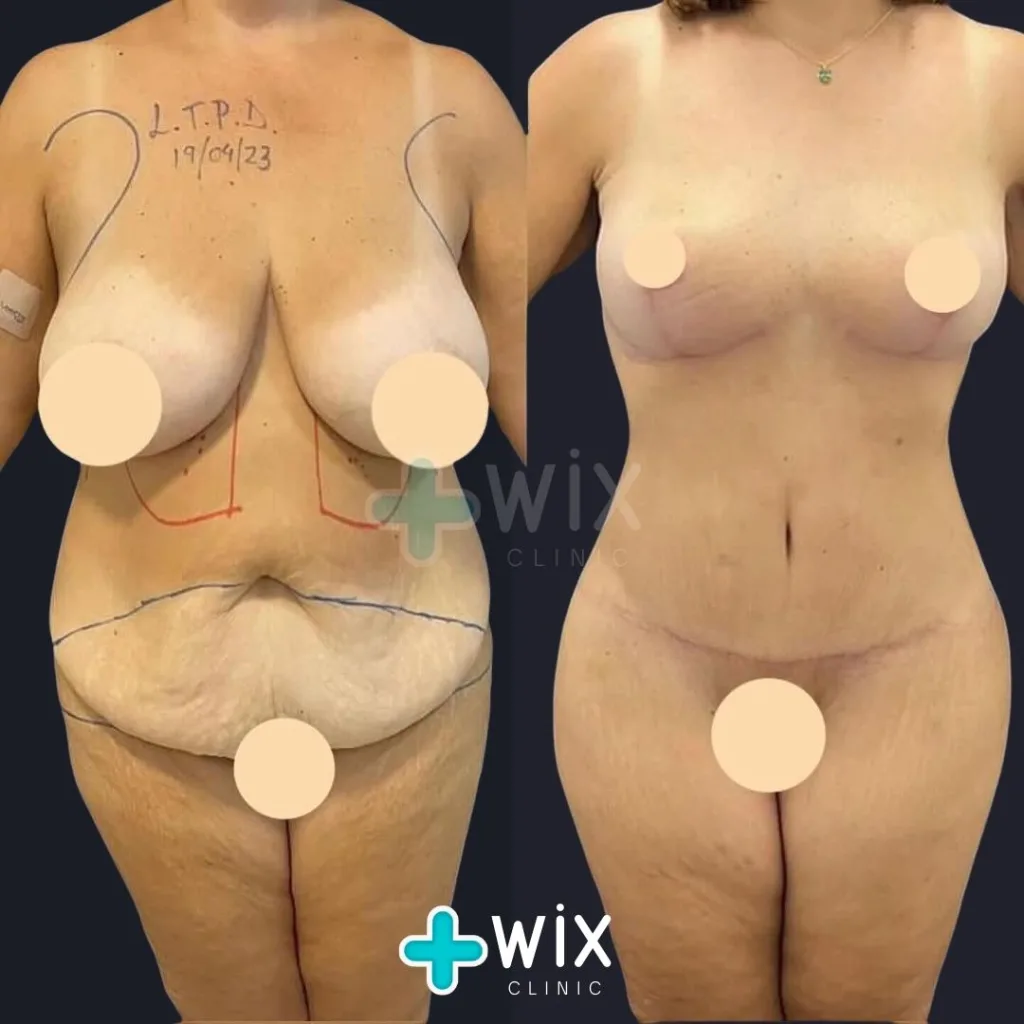 Tummy Tuck Before and After