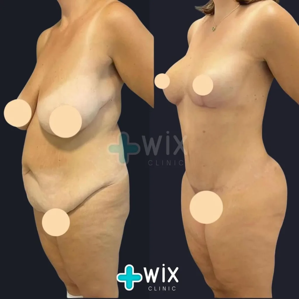 Tummy Tuck Before and After