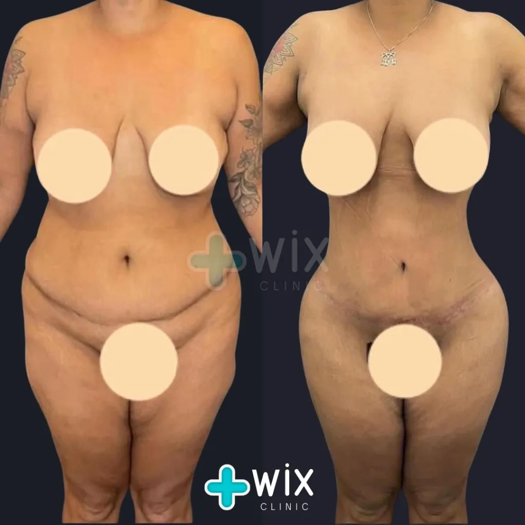 Tummy Tuck Before and After