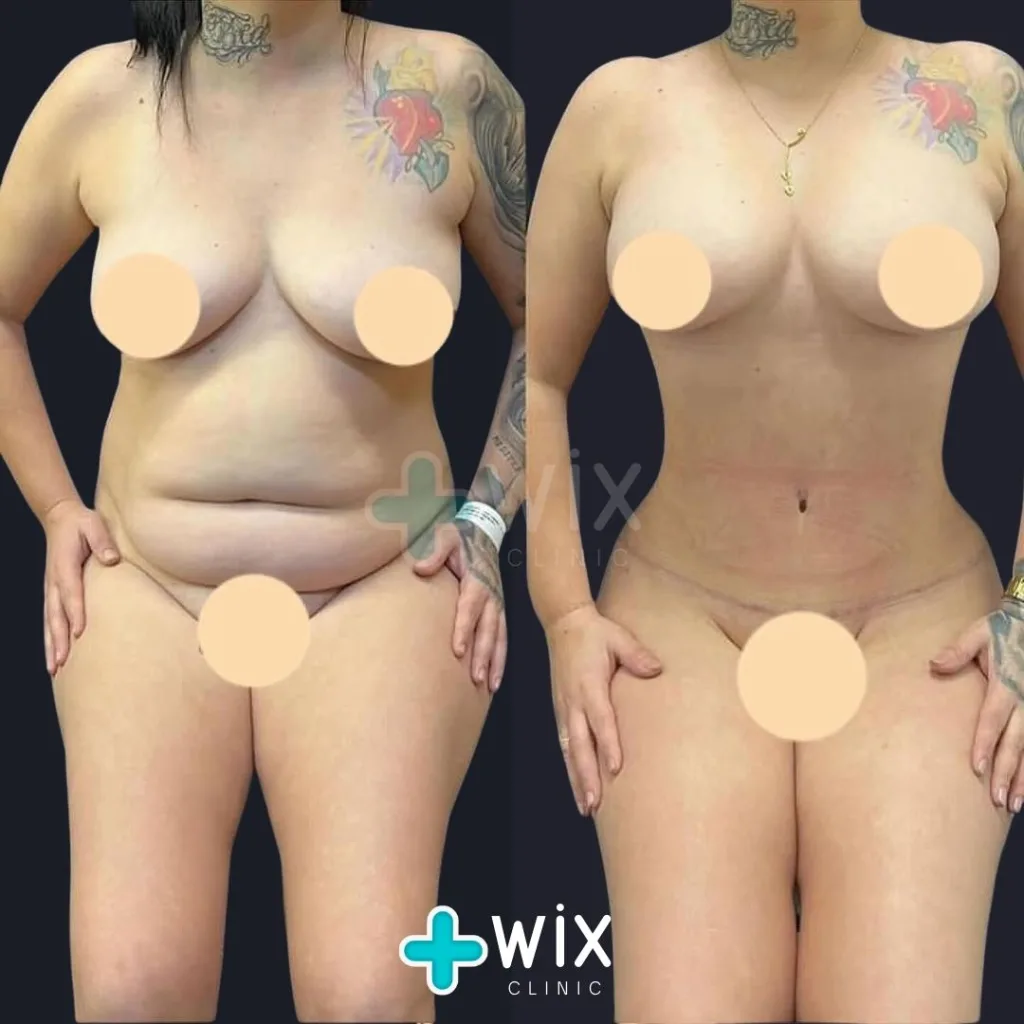 Tummy Tuck Before and After