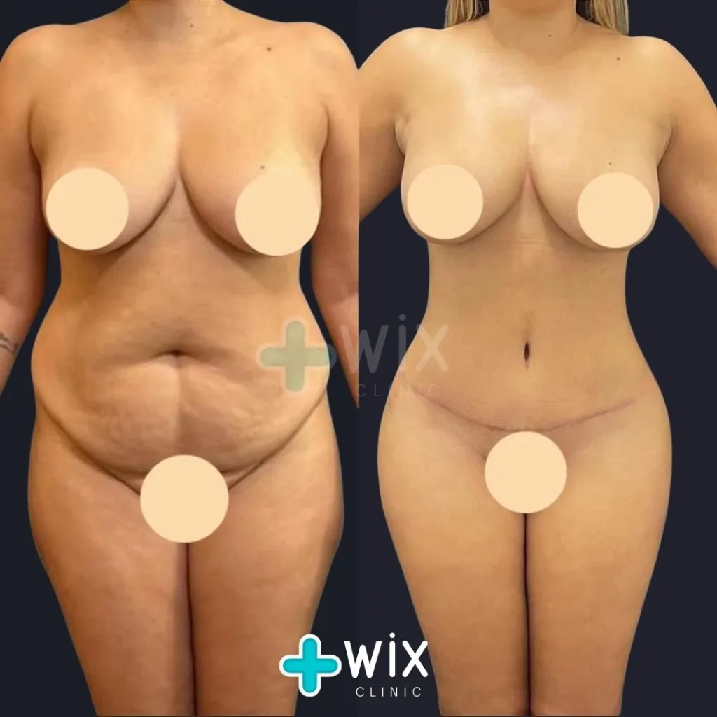 Tummy Tuck Before and After