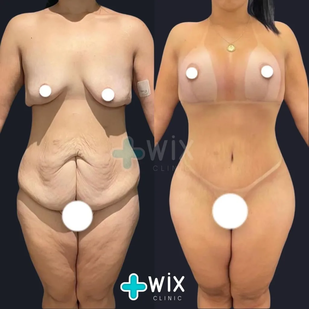 Tummy Tuck Before and After