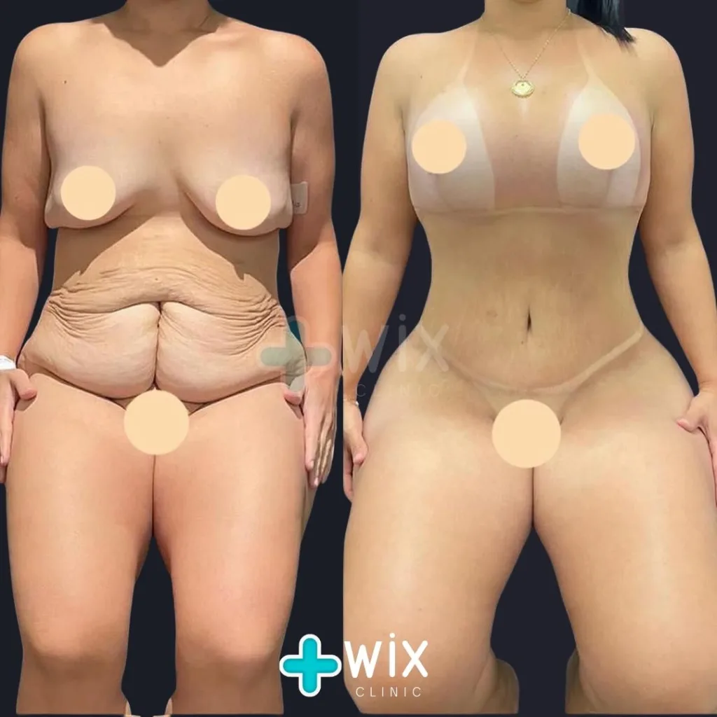 Tummy Tuck Before and After