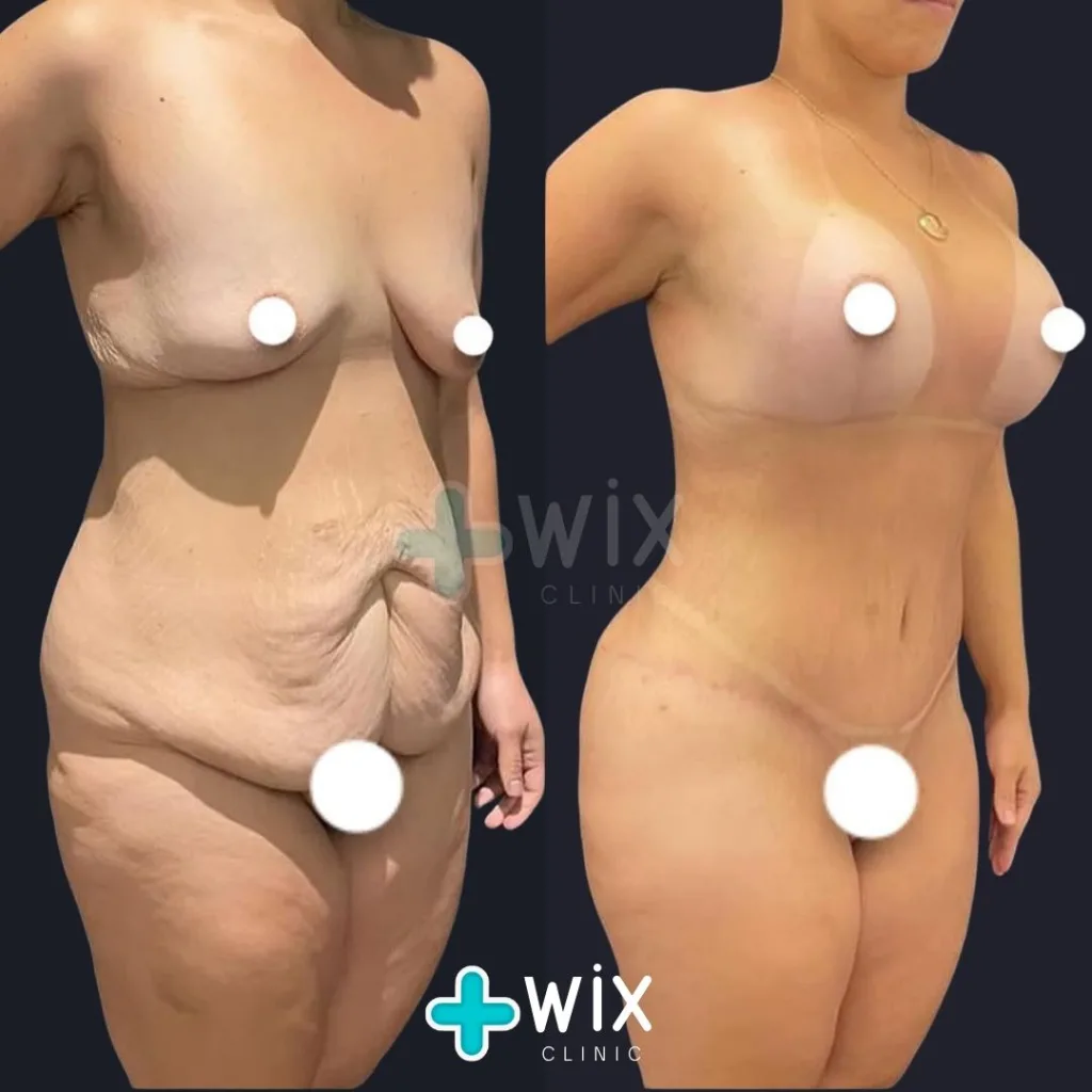 Tummy Tuck Before and After