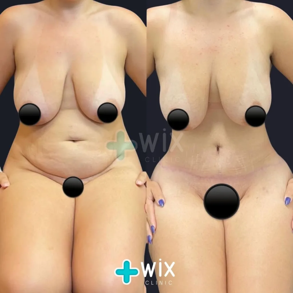 Tummy Tuck Before and After