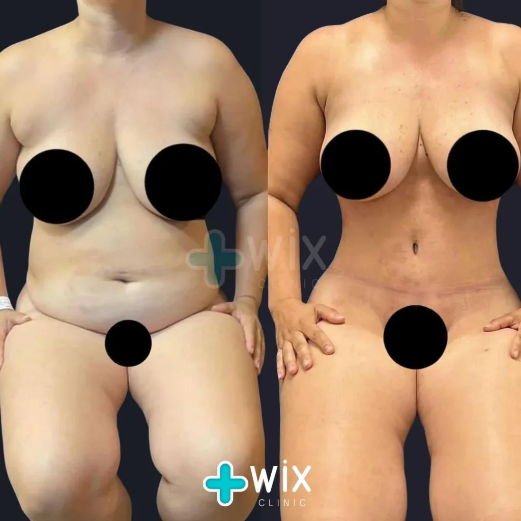 Tummy Tuck Before and After