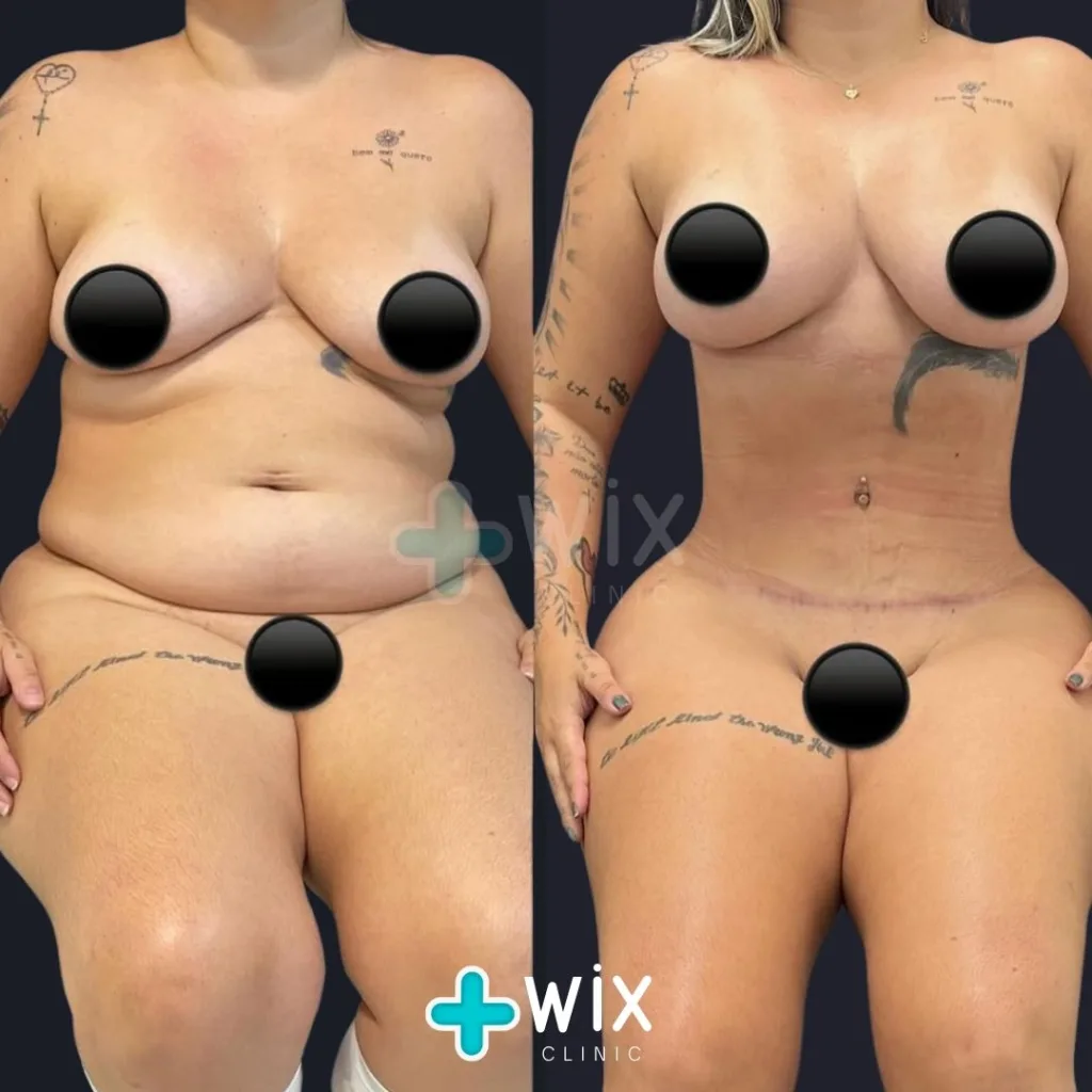 Tummy Tuck Before and After