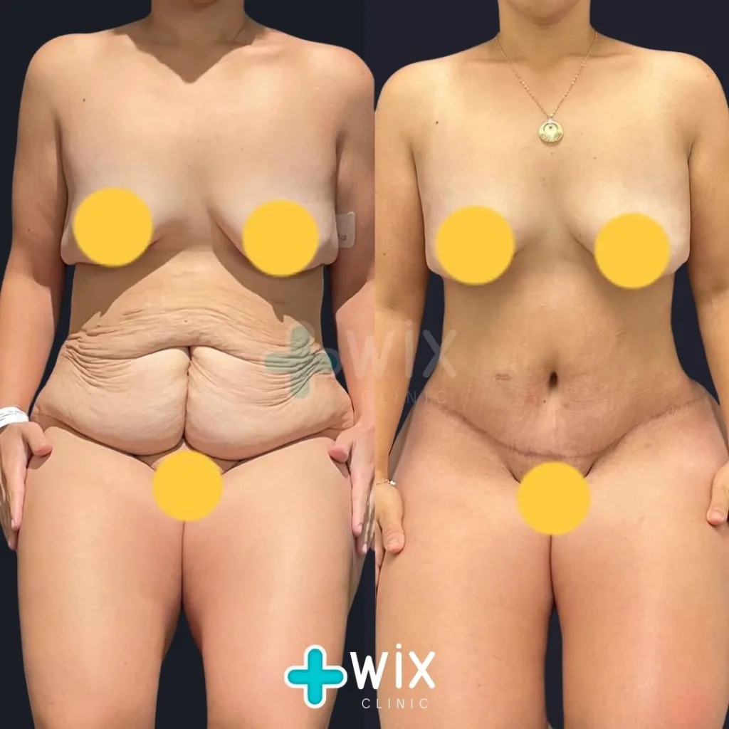 Tummy Tuck Before and After