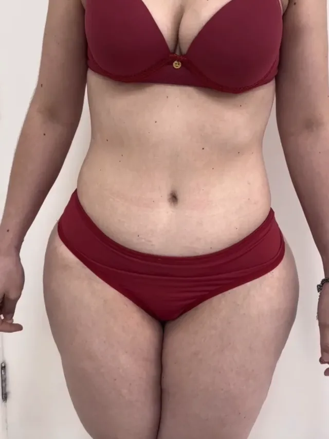 Alia – Tummy Tuck in Turkey Before and After